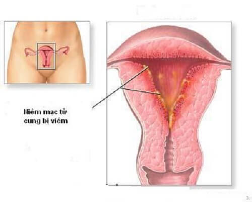 Viêm nội mạc cổ tử cung 